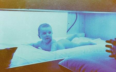 Crigler Najjar Syndrome